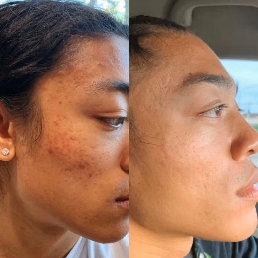 Microneedling at AesthetiSKN