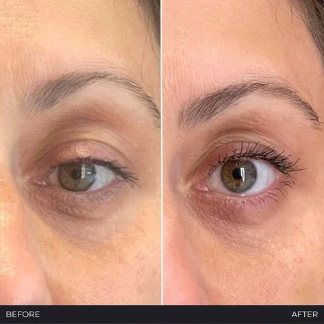 Side-by-side comparison showing a person's eye with dark circles and puffiness before and after skincare or makeup, highlighting improvements in skin appearance.