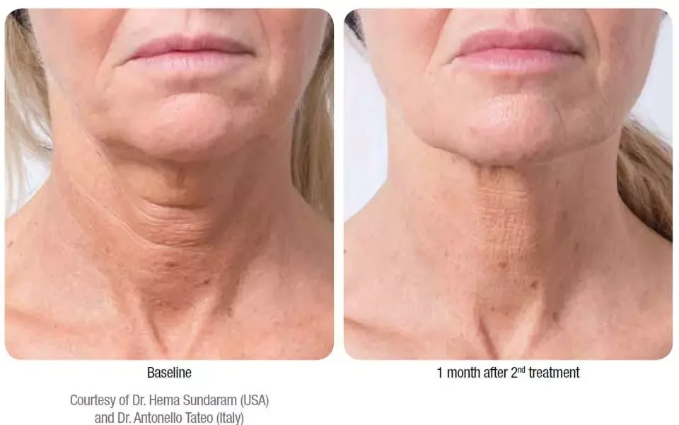 Profhilo at AesthetiSKN