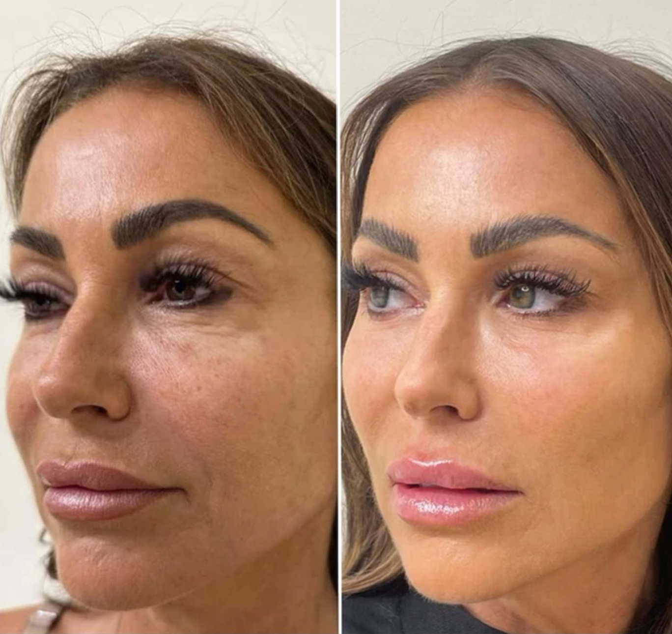 gummy smile toxin botox anti-wrinkle