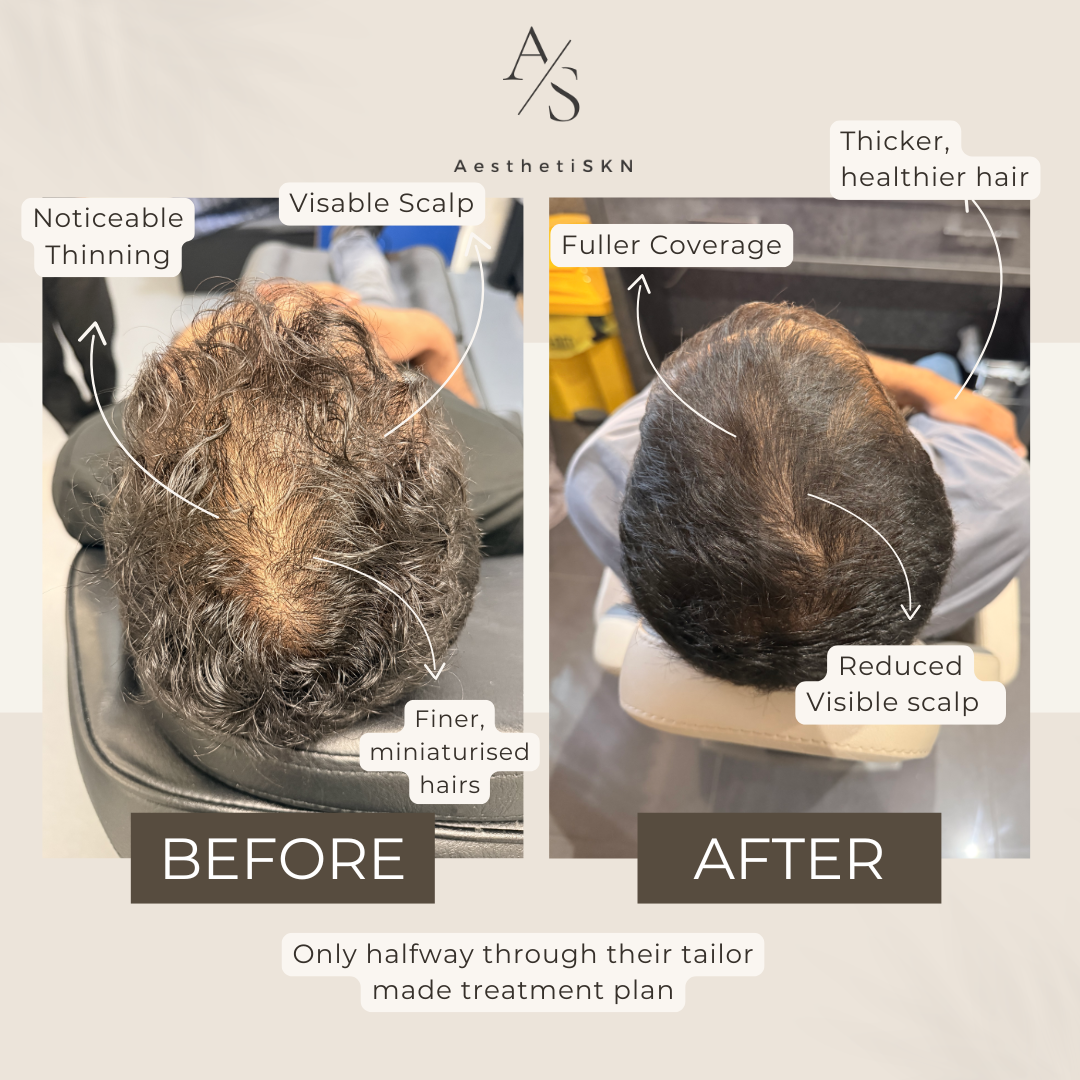 Hair rejuvenation package hair regrowth and thickening boosters. Male hair polynucleotides 