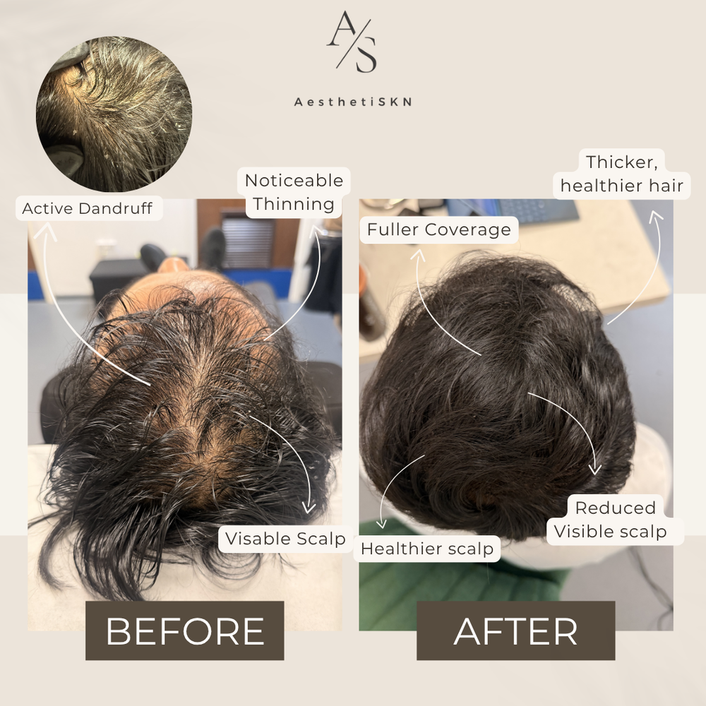 Thinning crown before and after: fuller coverage and a healthier scalp