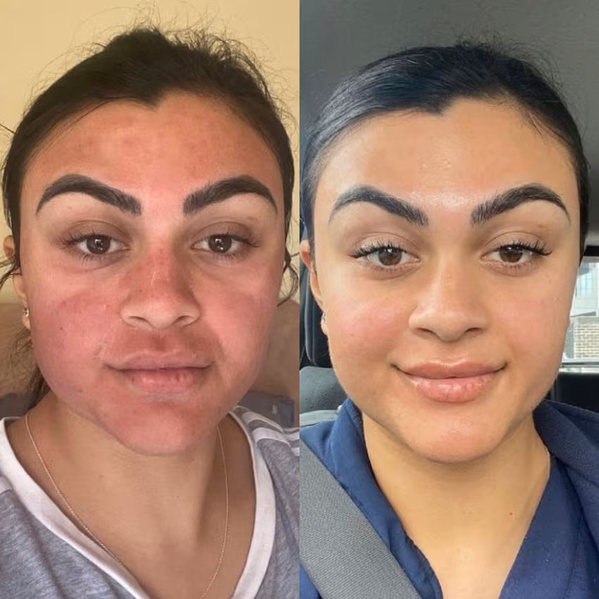 Skin clarity before and after
