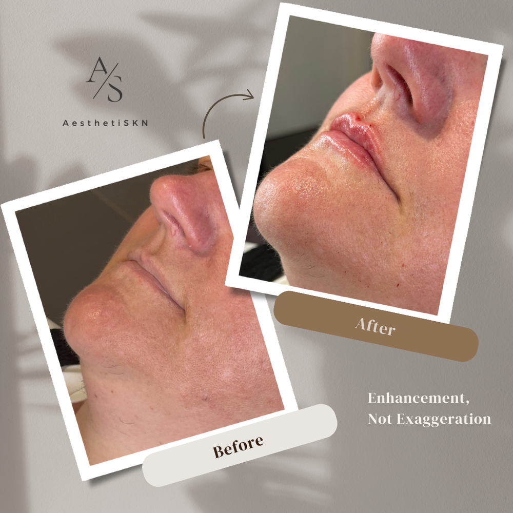 Subtle lip filler before and after