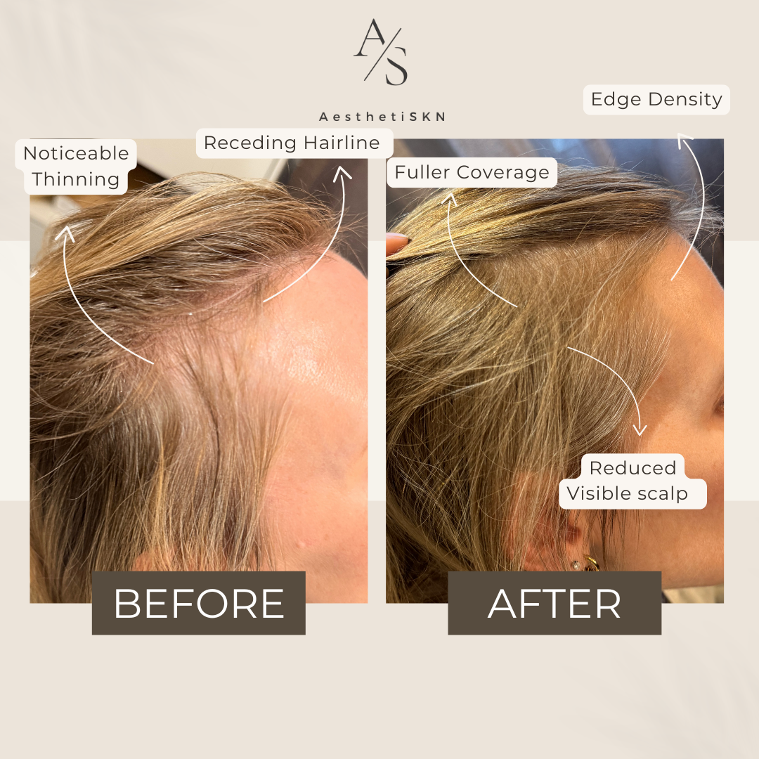 Hair rejuvenation package hair regrowth and thickening boosters. hair polynucleotides, prp, eoxomes 
