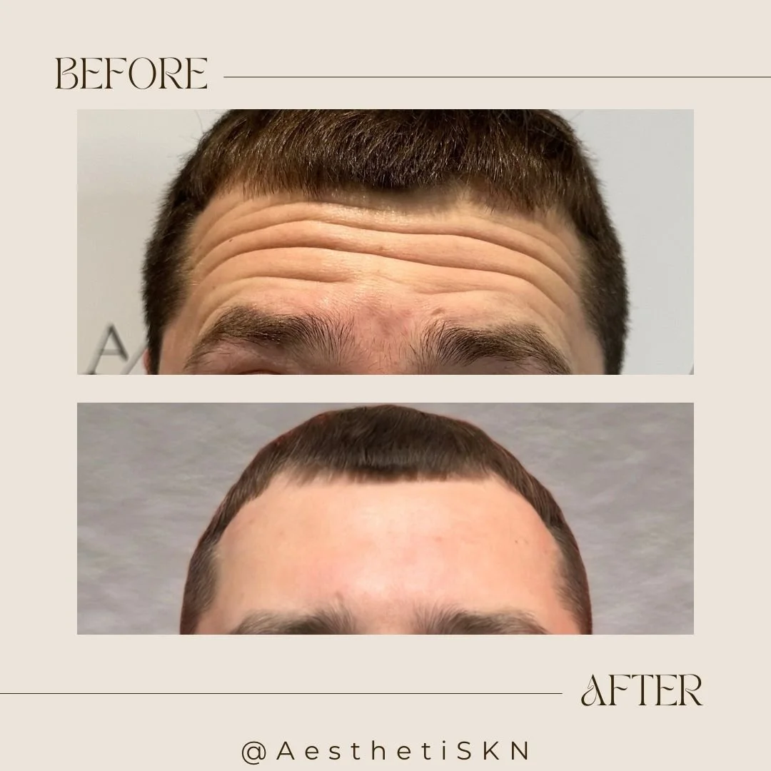Comparison of a man's forehead before and after a cosmetic procedure. The 'before' shows prominent forehead wrinkles, and the 'after' shows smooth skin with no visible wrinkles.