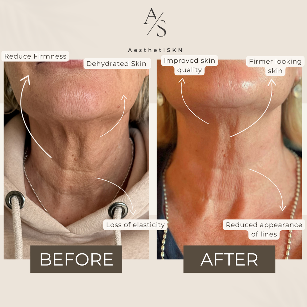Profhilo at AesthetiSKN Stoke-on-Trent