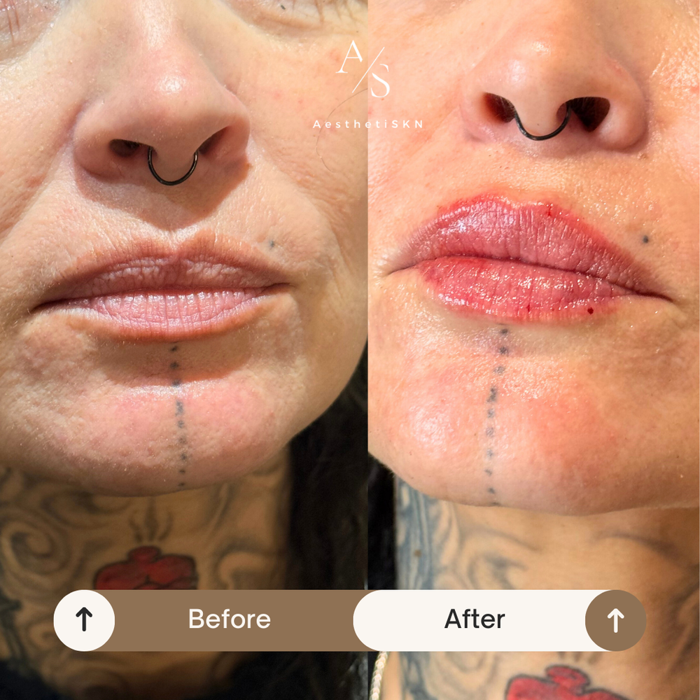 Lip filler before and after