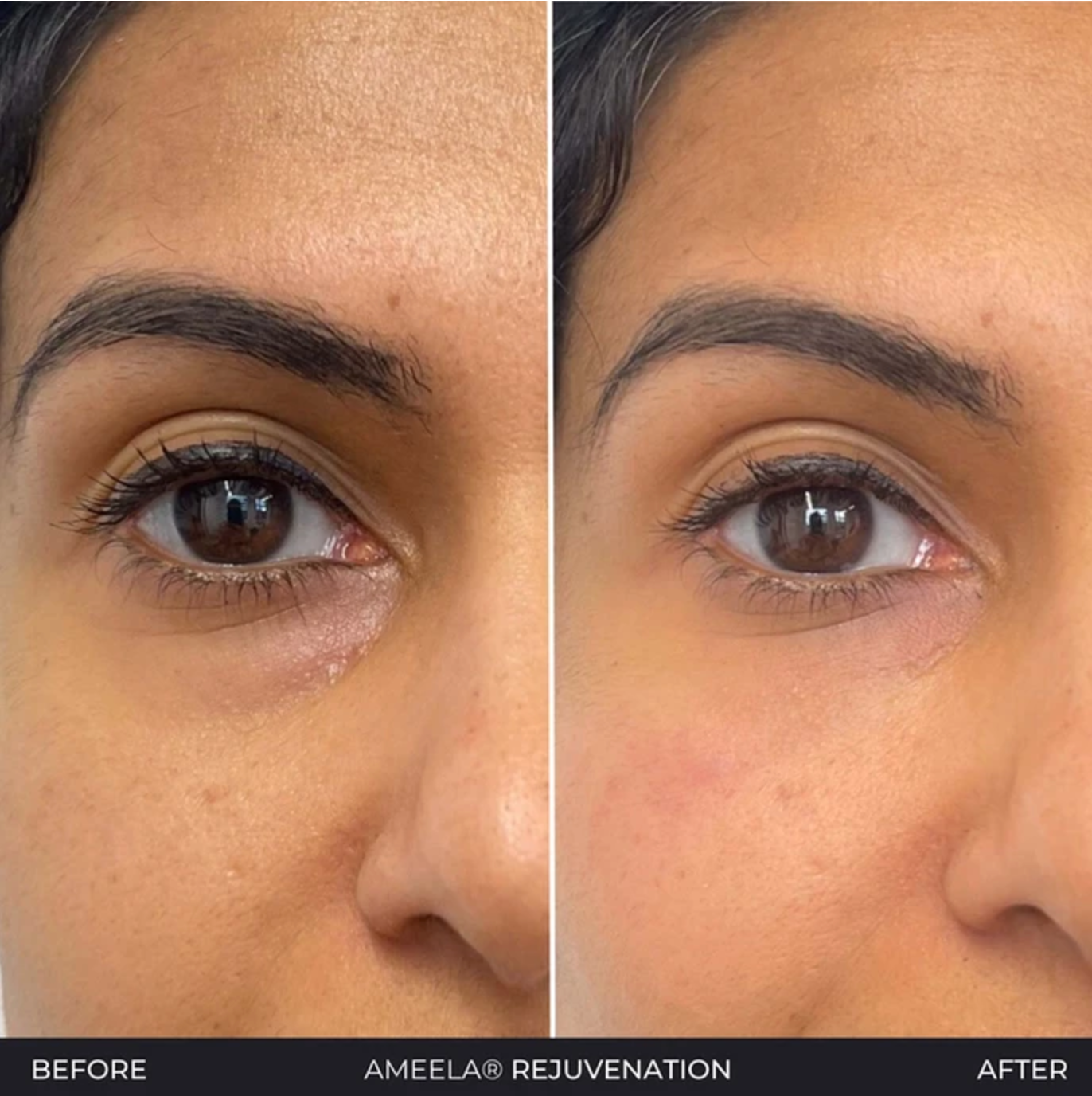 Dark circles under eye rejuvenation and brightening