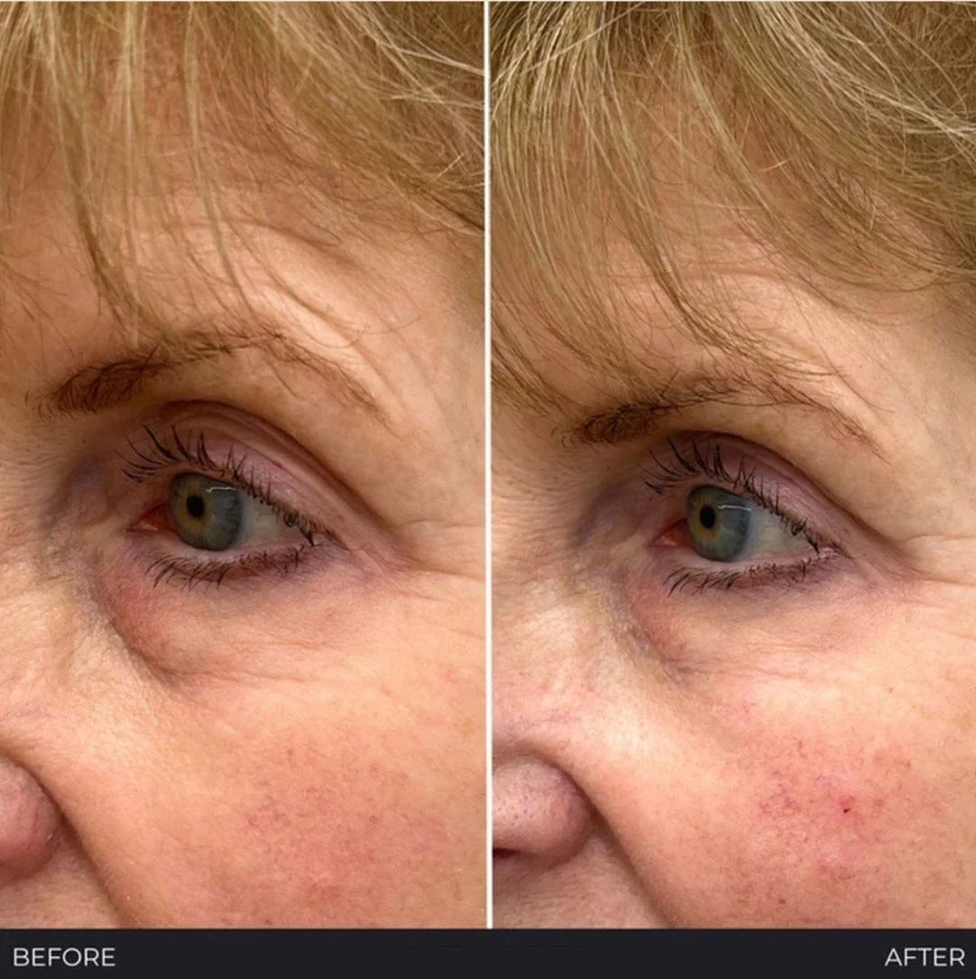 Side-by-side comparison image of a woman's face focusing on the eye area, showing skin before and after a skincare treatment. The left side labeled 'Before' shows more wrinkles and sagging skin around the eye, while the right side labeled 'After' shows smoother, tighter skin with fewer wrinkles.