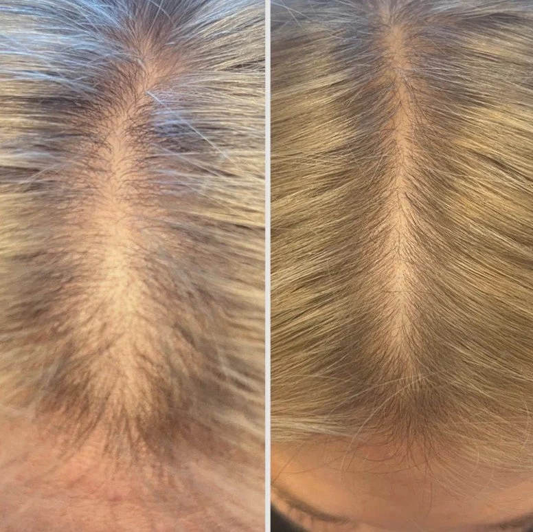 Exosome skin and scalp treatment at AesthetiSKN Stoke-on-Trent