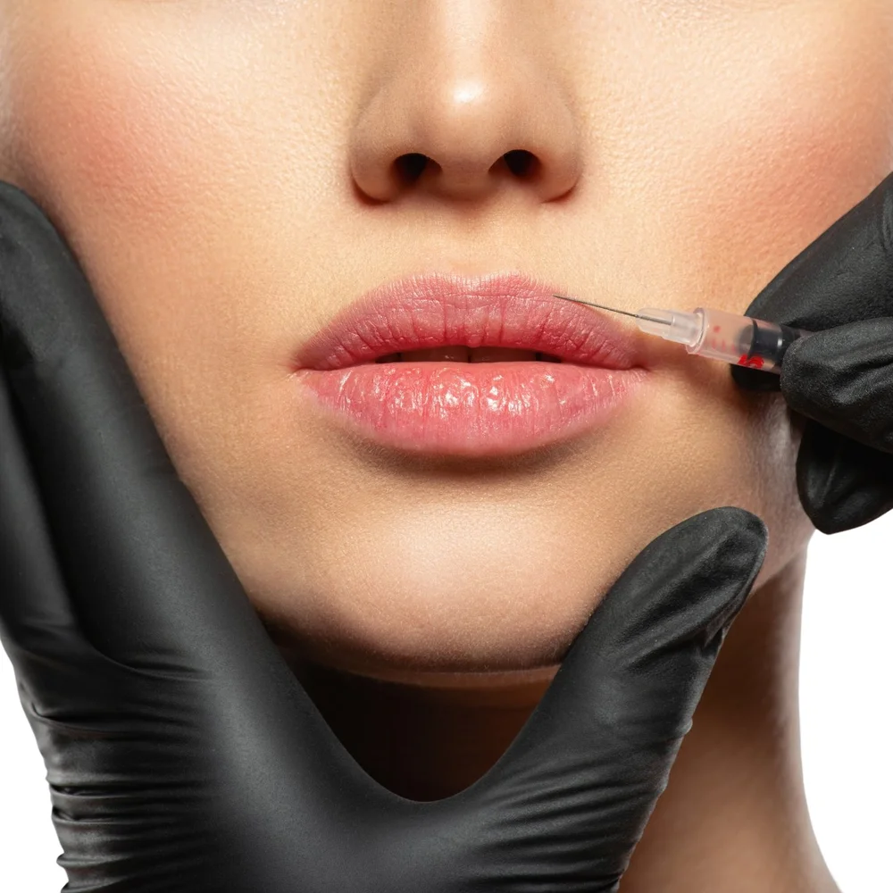 Natural-looking lip dermal filler treatment