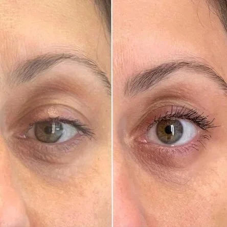 Under-eye before and after