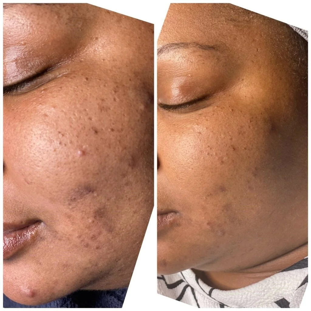 Chemical peel for acne on black skin 