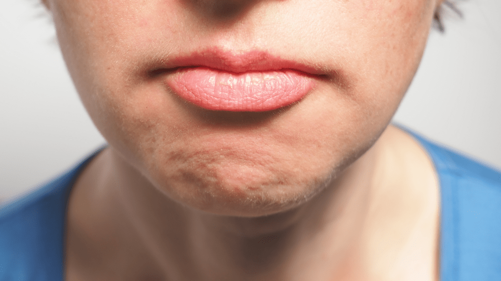 Chin dimpling