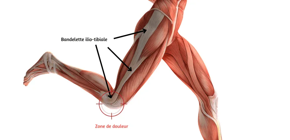 Le Syndrome de la Bandelette Ilio-Tibiale ou syndrome de l’essui-glace 