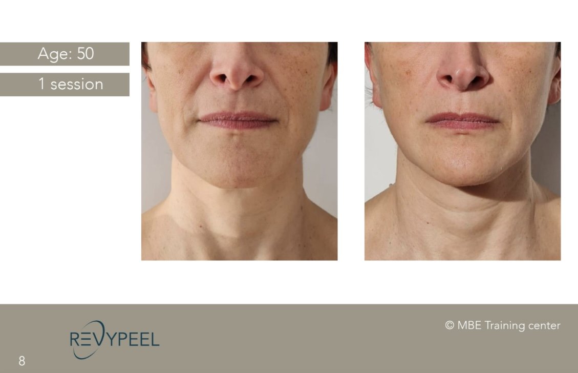 Revypeel high chemical peeling.jpeg