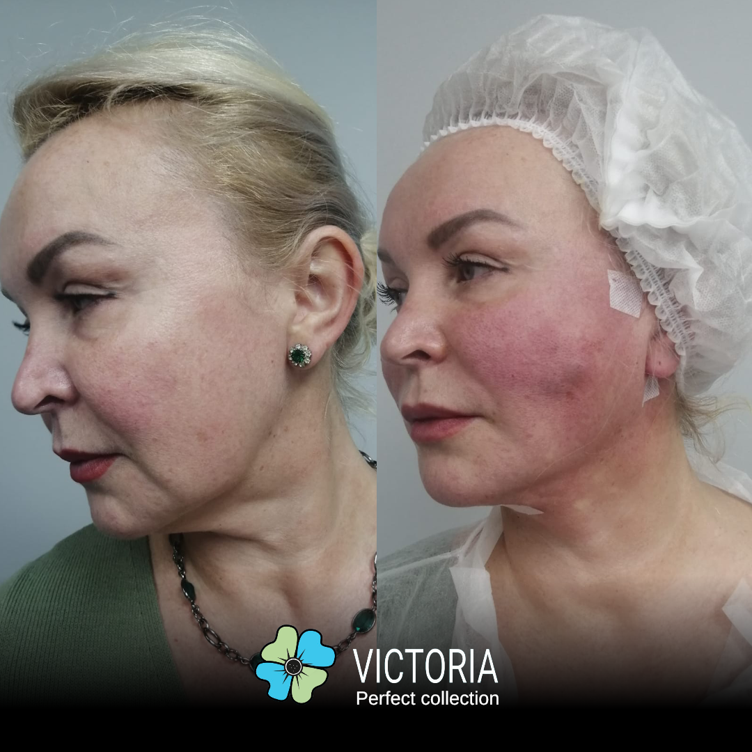 victoria pdo thread lifting course training in New York - Copy.PNG