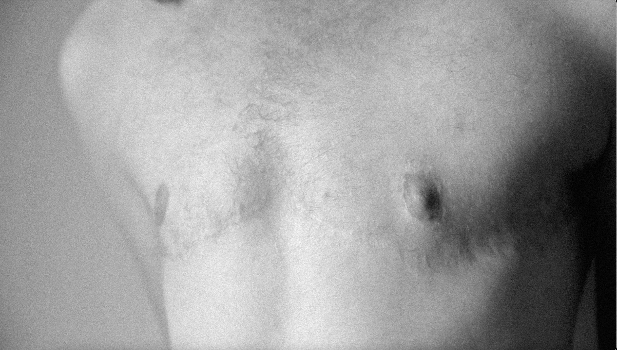 Gender-affirming chest reconstruction