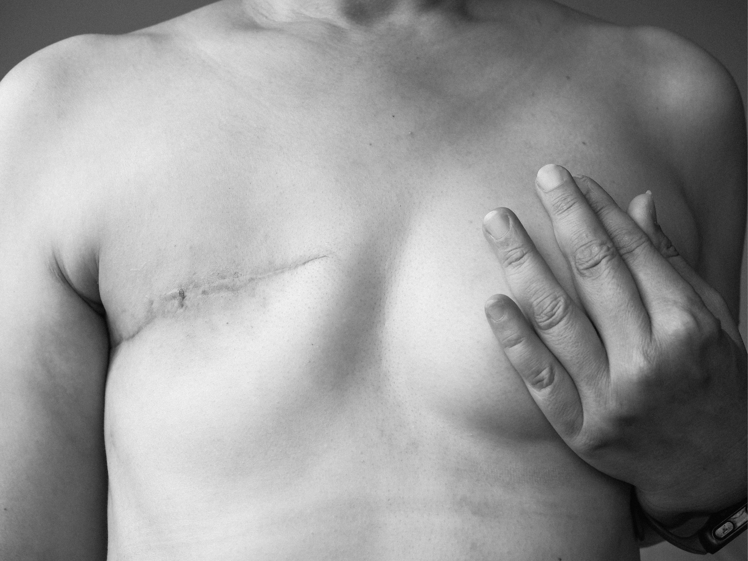 Surgery scars