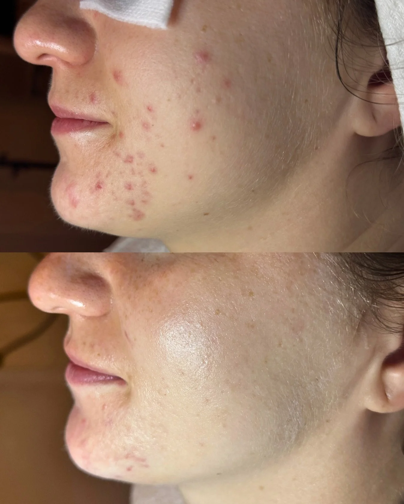 Breakouts met their match 👏🏽 This gorgeous soul moved to NYC a couple of years ago, worried that her acne-prone skin might act up again (we all know the acne journey has its ups and downs!).

We&rsquo;ve spent the last 6 months fine-tuning her at-h
