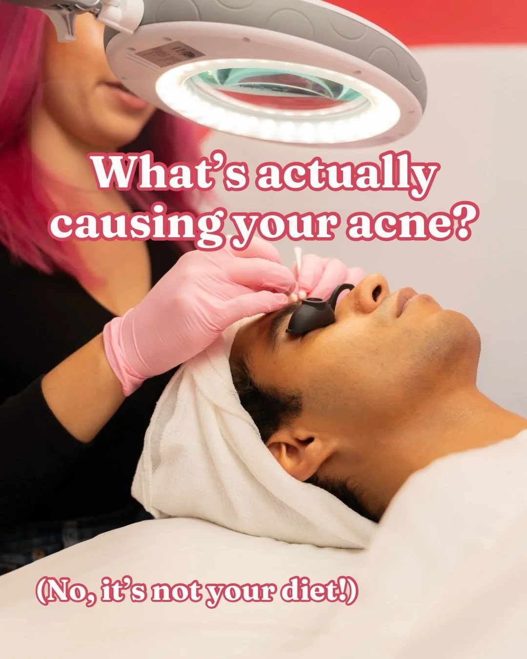 If you have acne, you&rsquo;ve probably been blamed for it at some point.

&ldquo;You need to cut out XYZ foods&rdquo;
&ldquo;You&rsquo;re too stressed&rdquo;
&ldquo;You should wash your face more&rdquo;
&ldquo;Do you change your pillow cases enough?