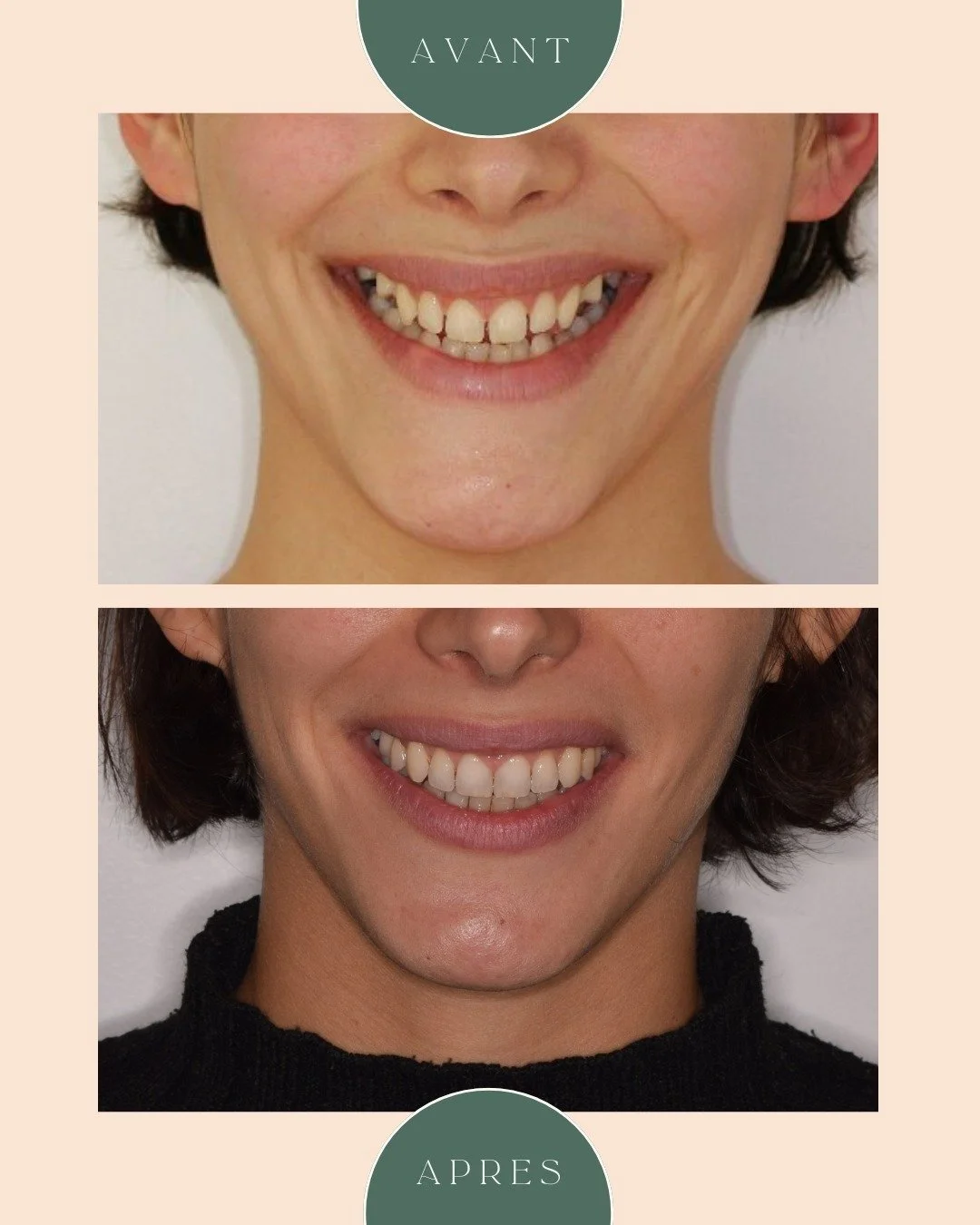 Avant - Apr&egrave;s ✨ Aujourd&rsquo;hui, je vous pr&eacute;sente le cas d&rsquo;une patiente de 28 ans qui avait trois ag&eacute;n&eacute;sies (absence de d&eacute;veloppement de dents) : deux deuxi&egrave;mes pr&eacute;molaires en haut et la deuxi&