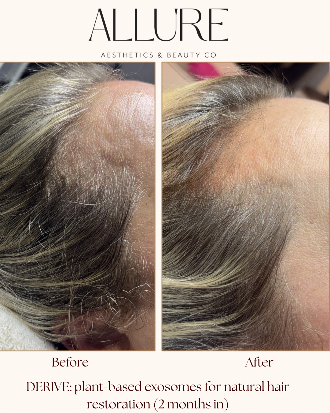 12 hours post BioTouch Precision Microneedling with SERA AK Mesotherapy Firming Serum - 1.PNG