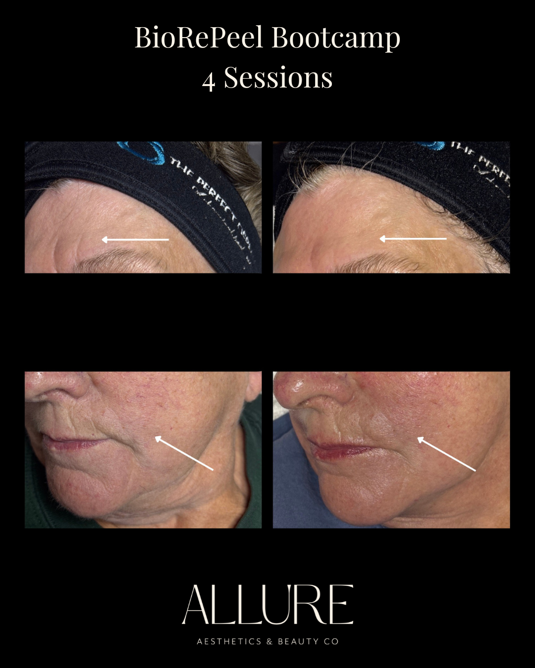 12 hours post BioTouch Precision Microneedling with SERA AK Mesotherapy Firming Serum - 4.PNG