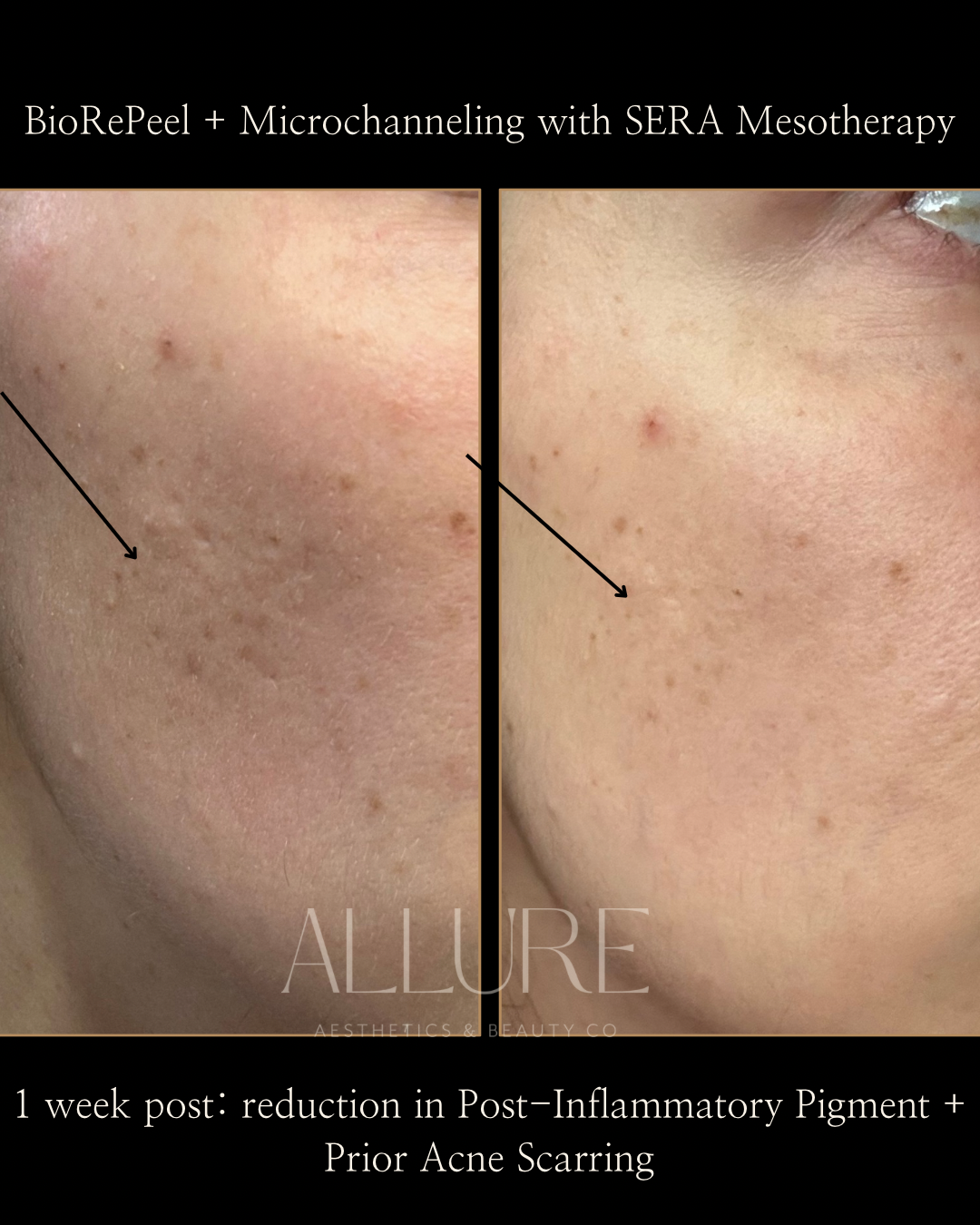 BioRePeel + Microchanneling with SERA Mesotherapy - 6.png