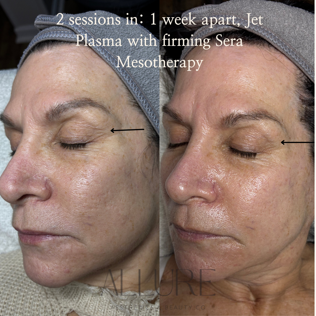 1 GLO2FACIAL HYDRATE DELUXE immediate beforeafter.zip - 2.png
