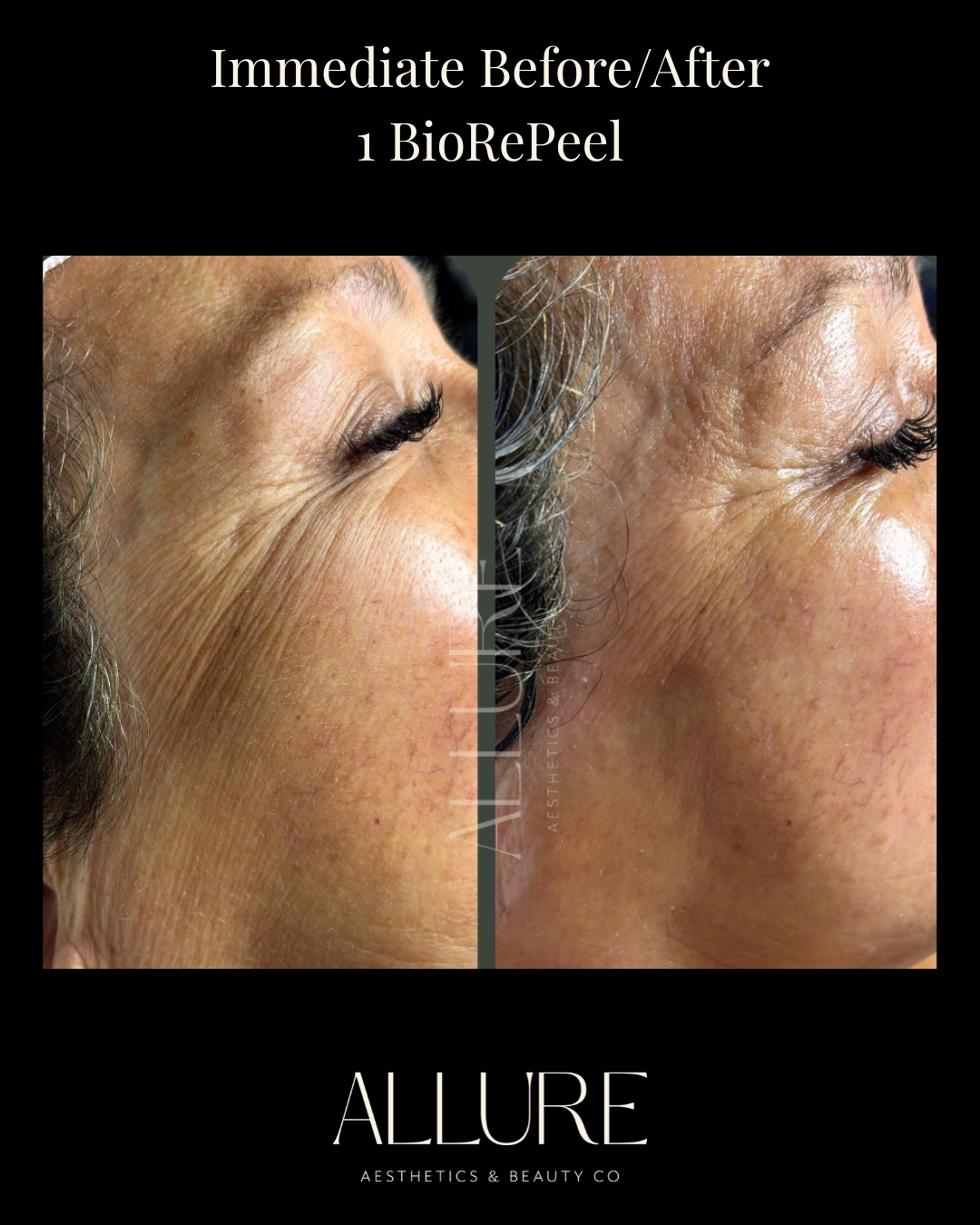 12 hours post BioTouch Precision Microneedling with SERA AK Mesotherapy Firming Serum - 3.PNG