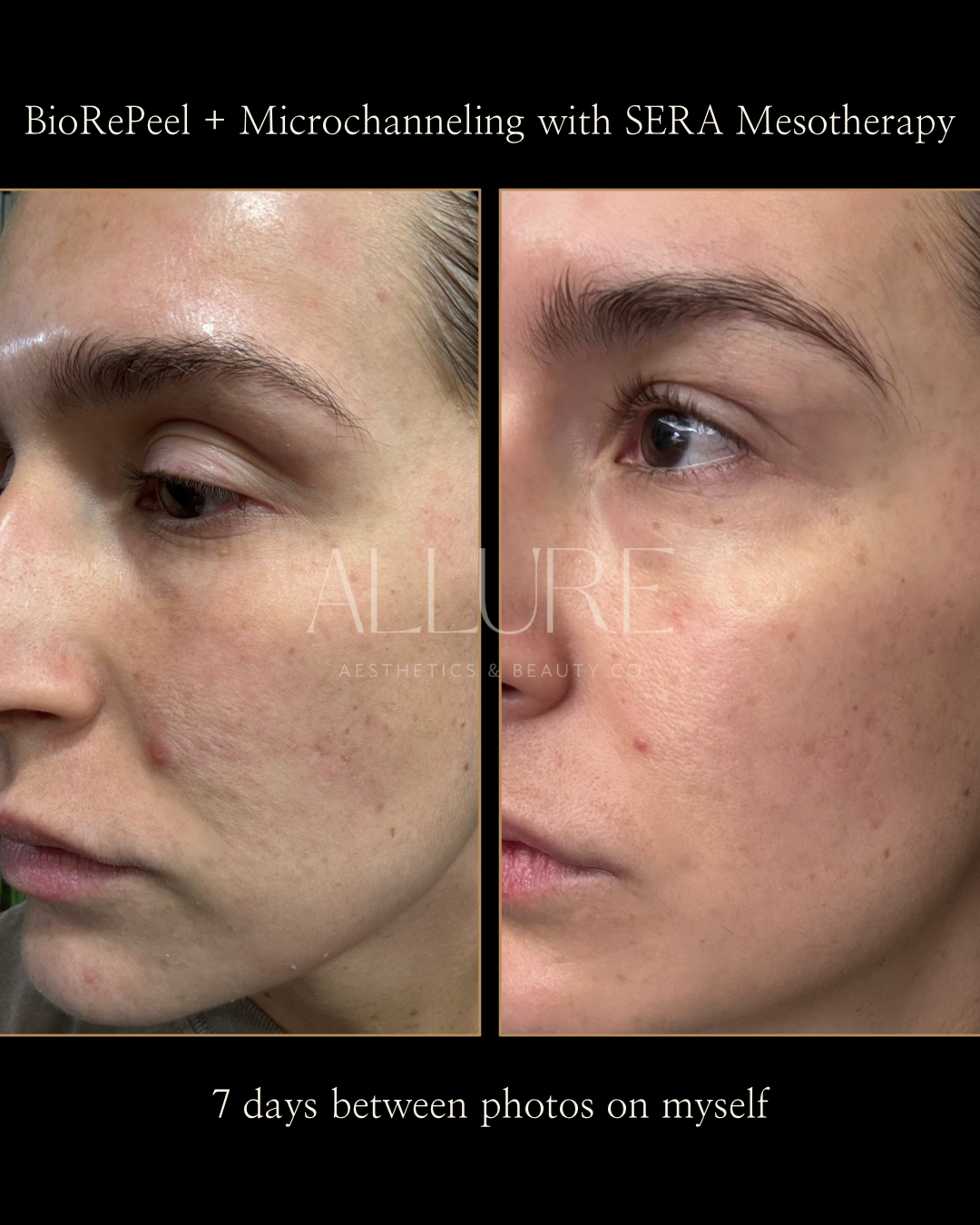 BioRePeel + Microchanneling with SERA Mesotherapy - 1.png