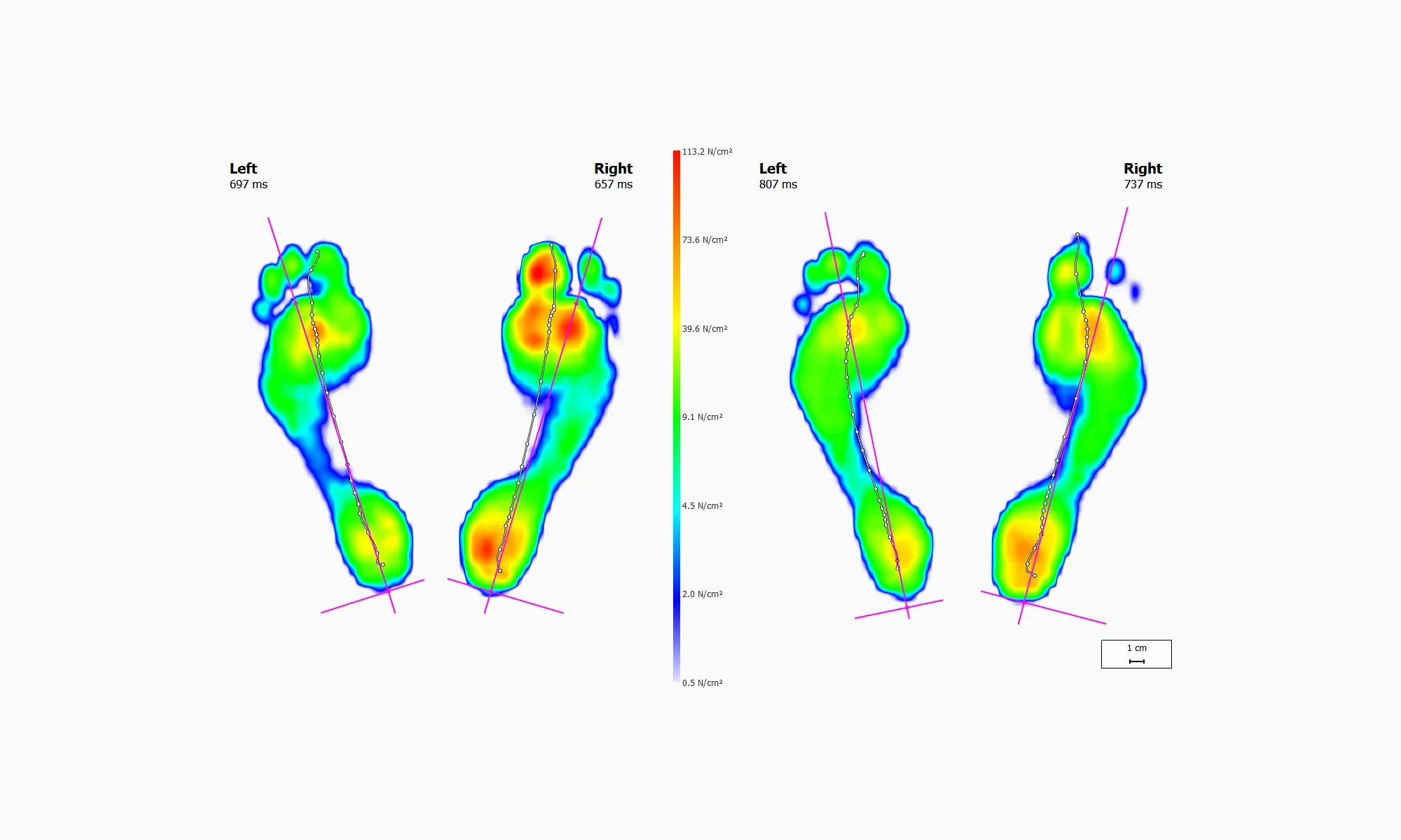 Comparison of foot pressure distribution on left and right feet, shown as colorful heat maps with pressure levels indicated by color scale from blue to red.