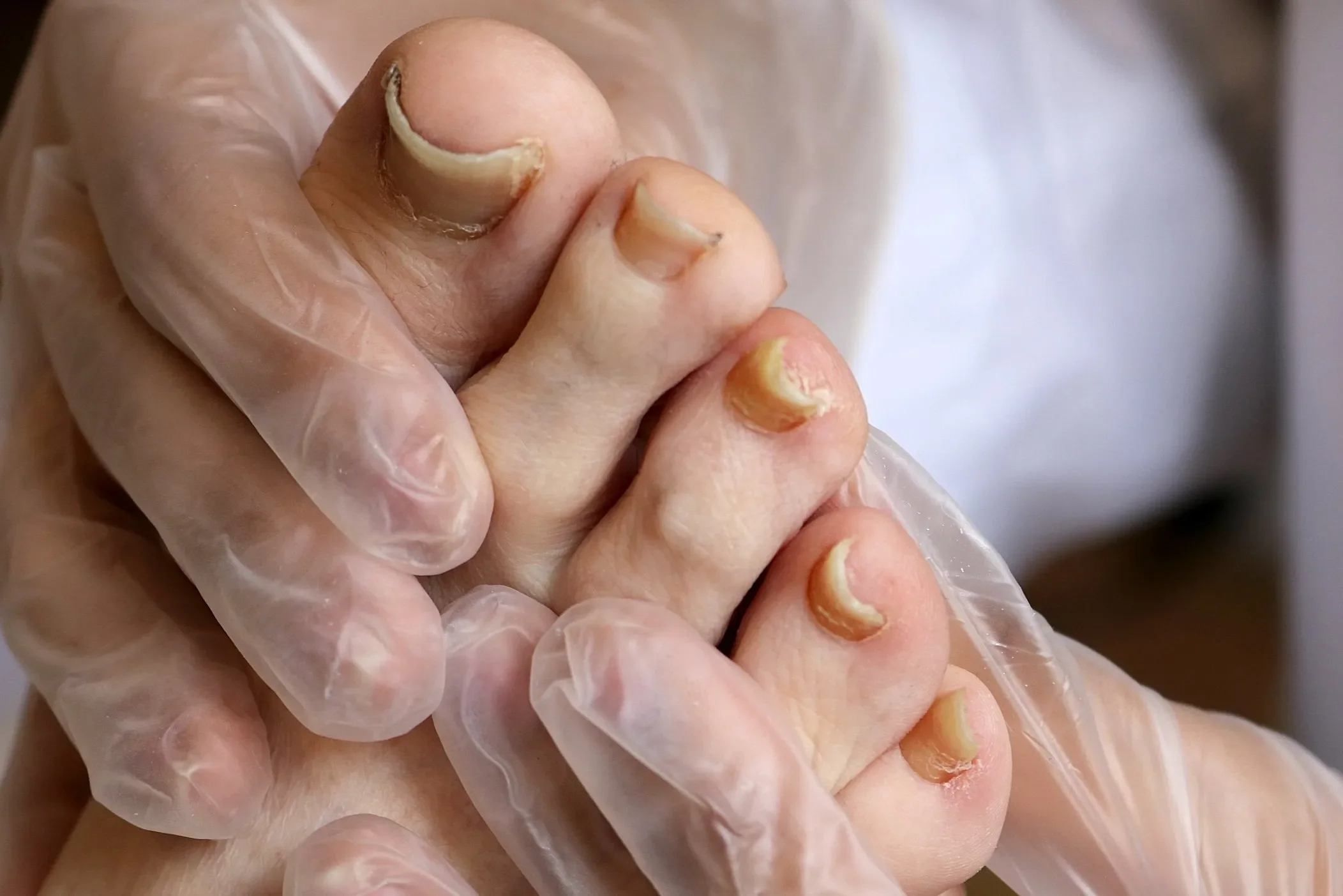 Close-up of a hand wearing a clear glove, with fingernails that are damaged and peeling.