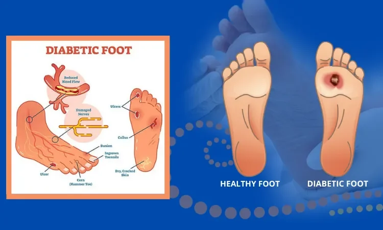 Diagram of a diabetic foot showing reduced blood flow, damaged nerves, ulcers, bunion, ingrown toenails, and dry, cracked skin, with comparison of a healthy foot and a diabetic foot.