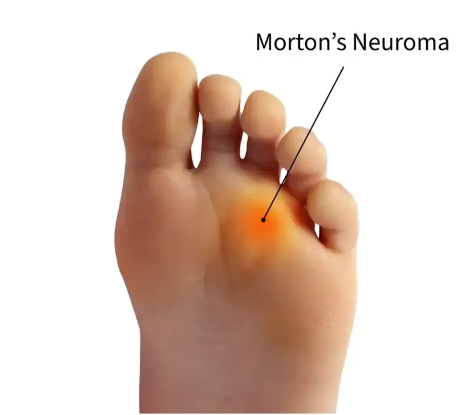 A hand with a highlighted area indicating Morton’s Neuroma between the third and fourth toes.