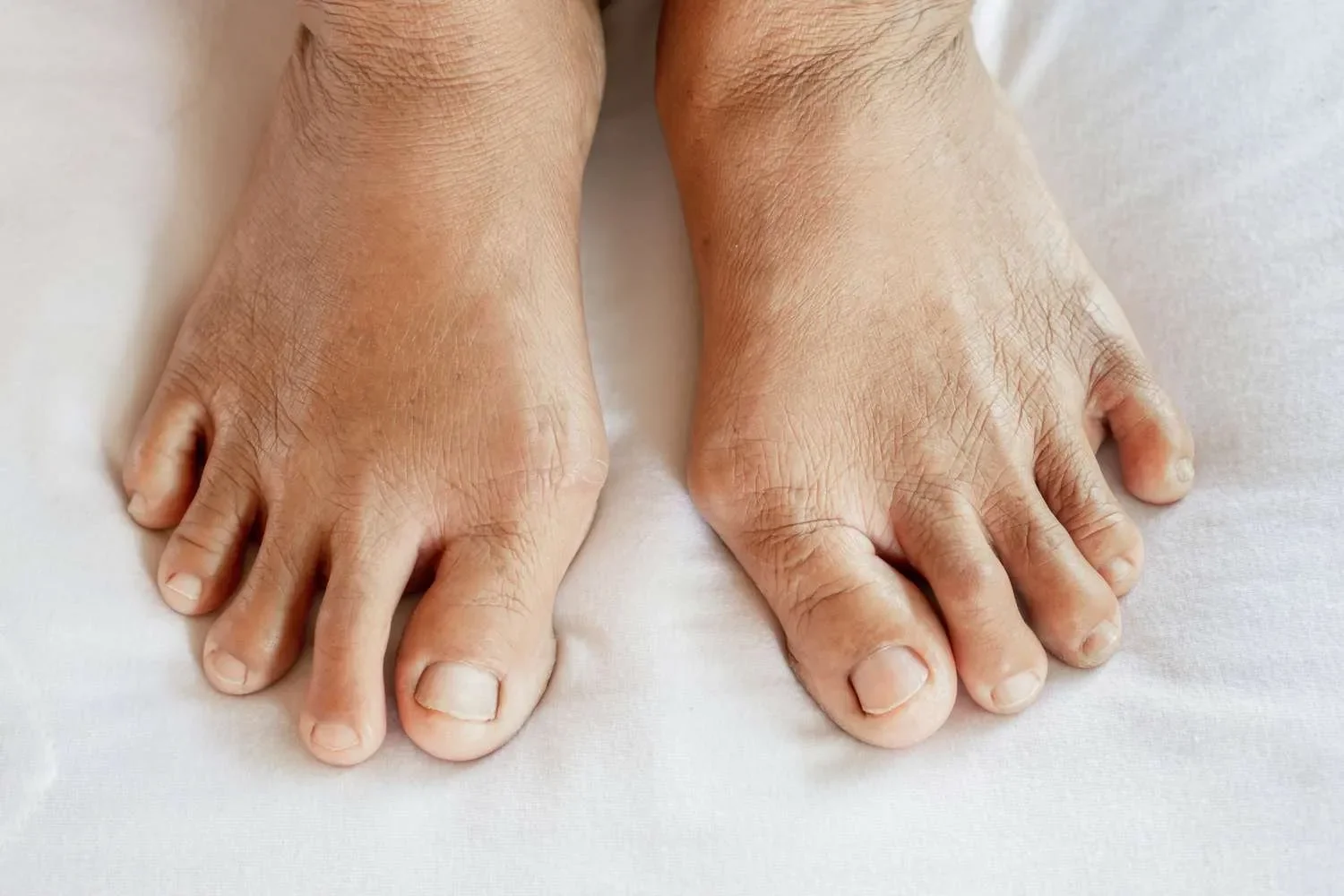 Close-up of human feet with toes on a white surface, showing skin texture and toenails.