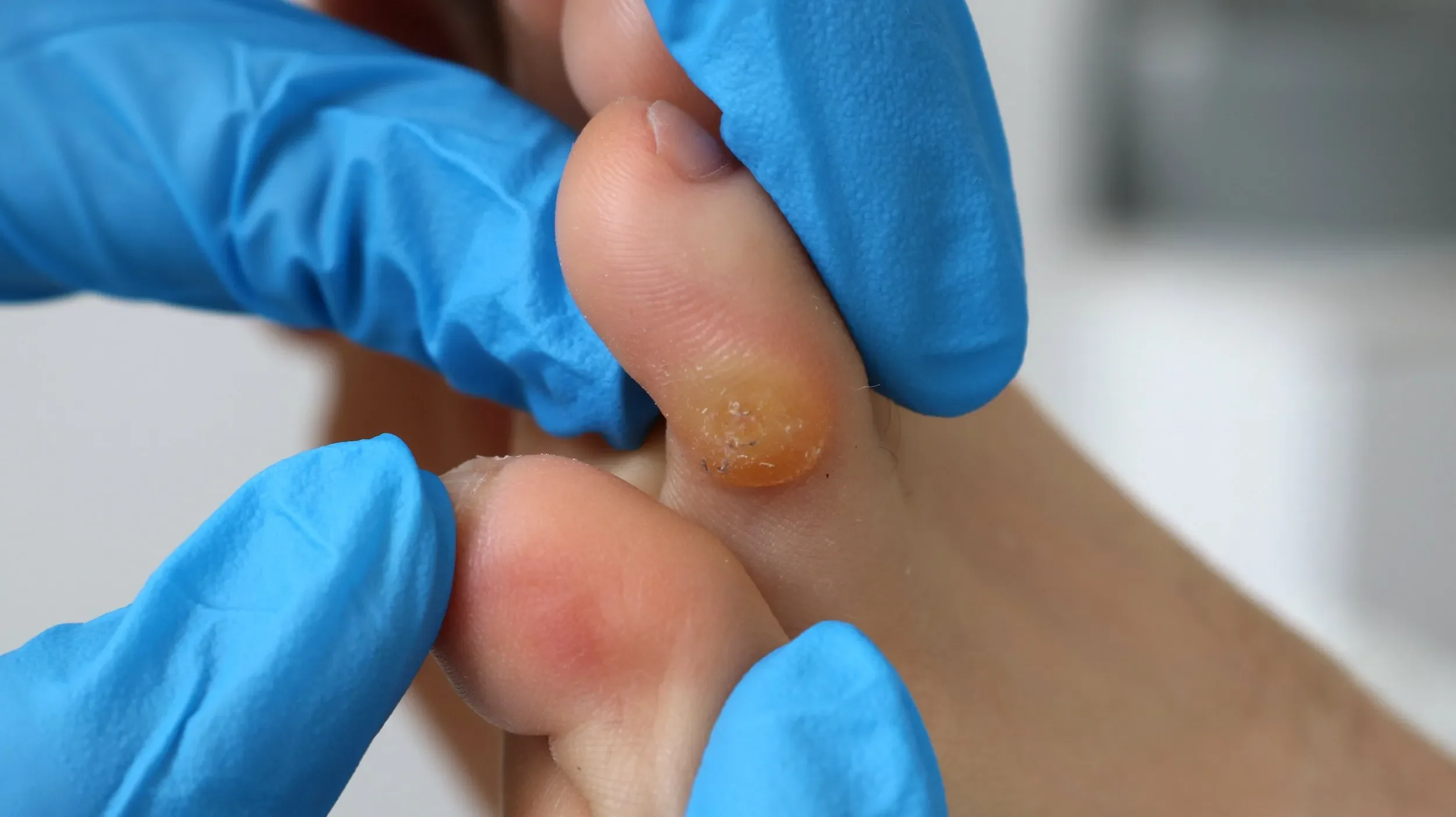 Close-up of a person wearing blue gloves extracting a yellowish, infected toenail from their toe.