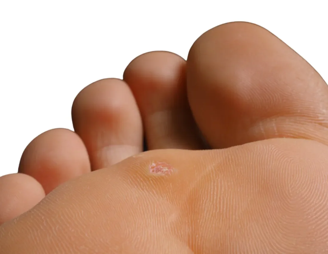 Close-up of a person's foot with a small wound on the ball of the foot, showing toes and skin details.