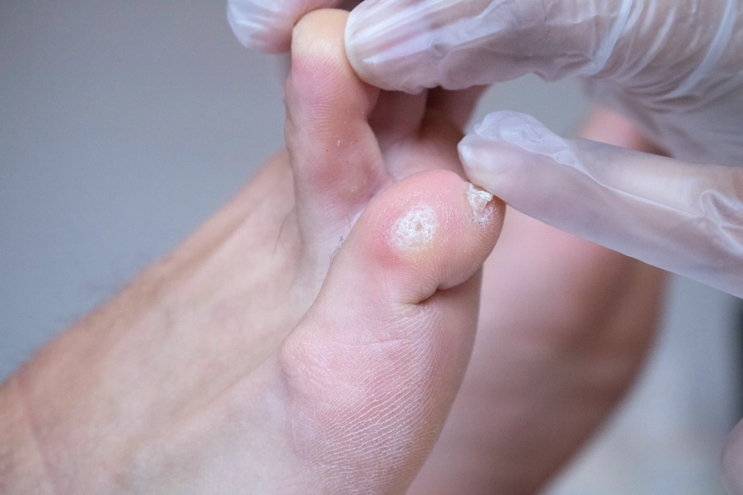 Close-up of a person's finger with a toenail, being examined or treated by a person wearing disposable gloves.