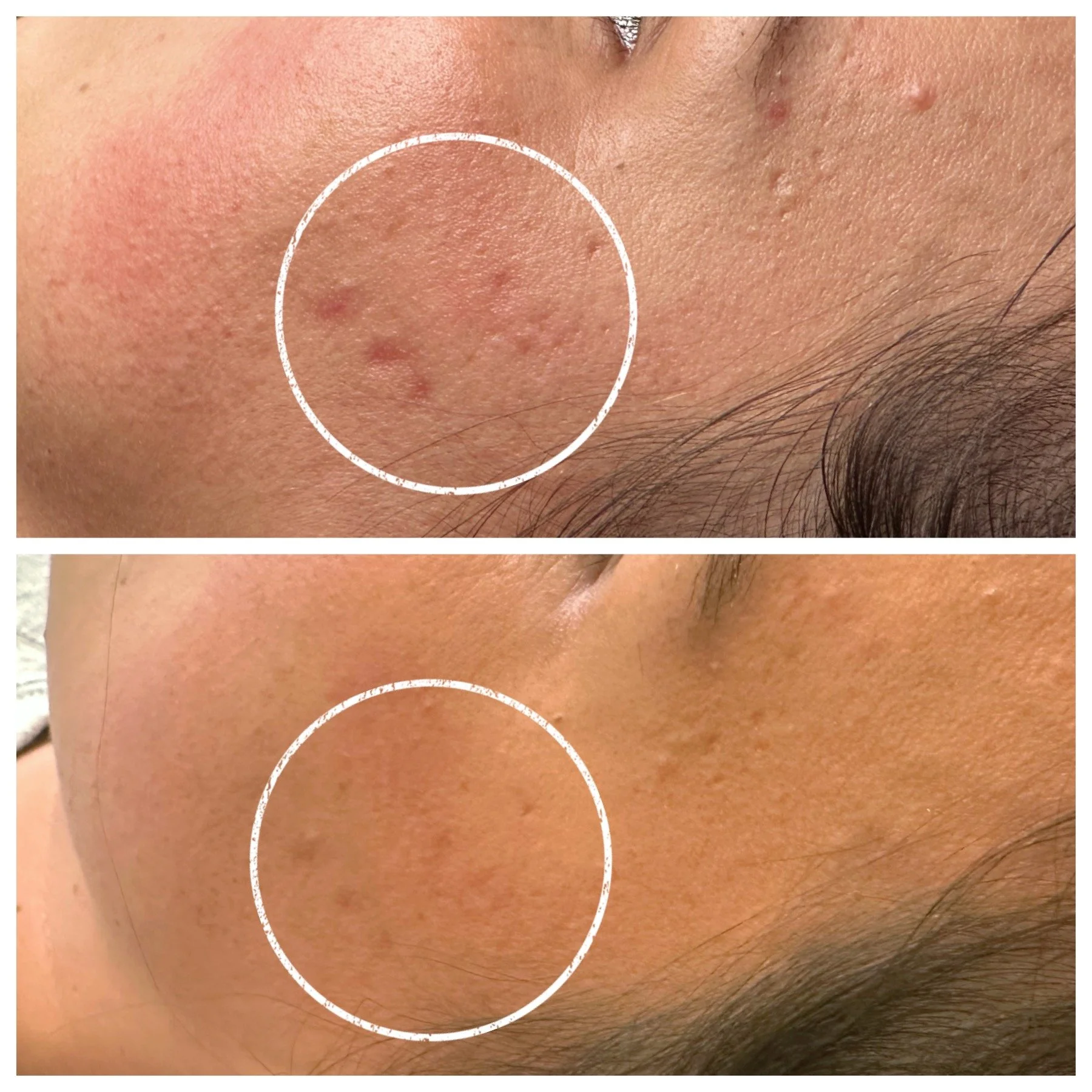 Before and after two ProCell treatments