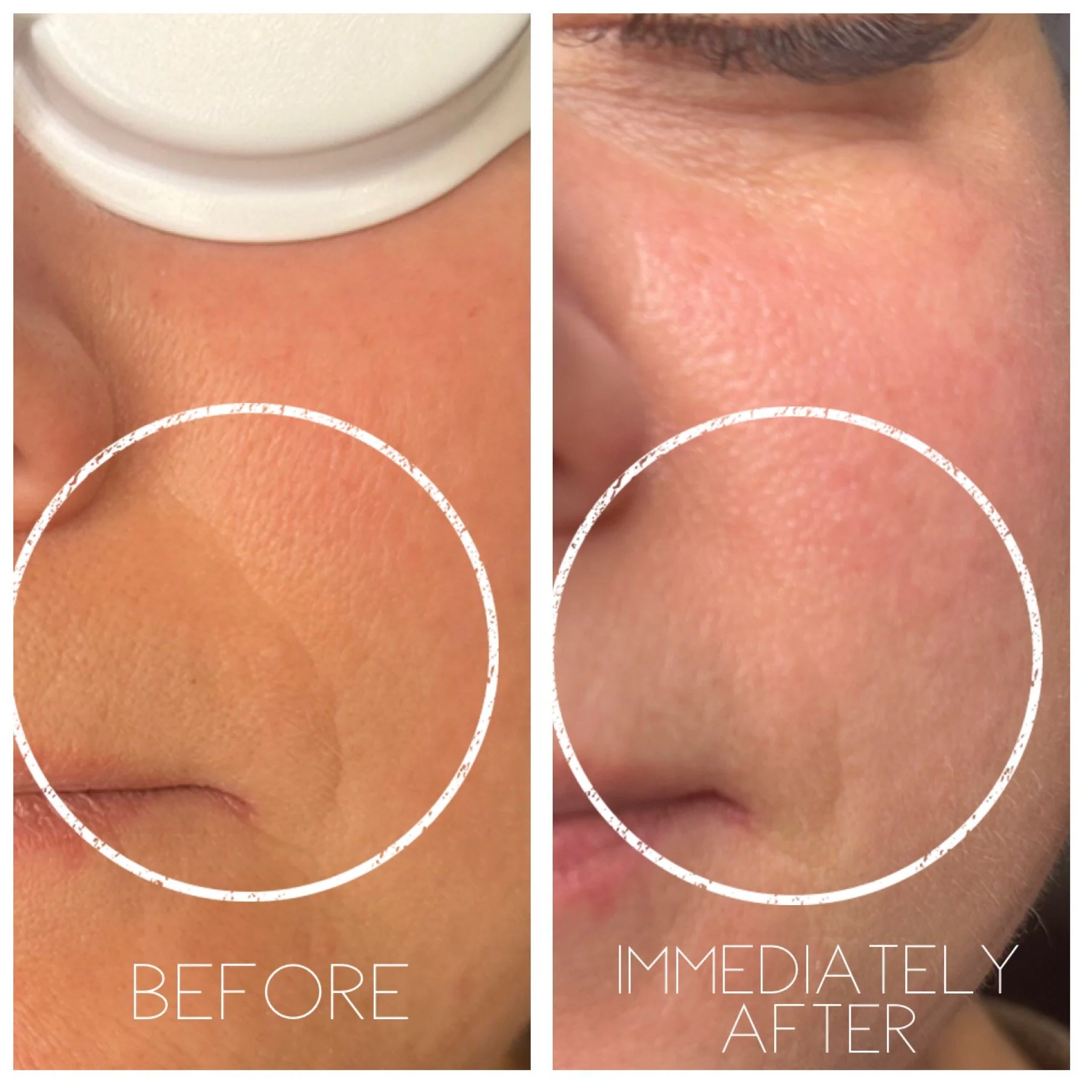 Before and after one laser treatment for fine lines and collagen production