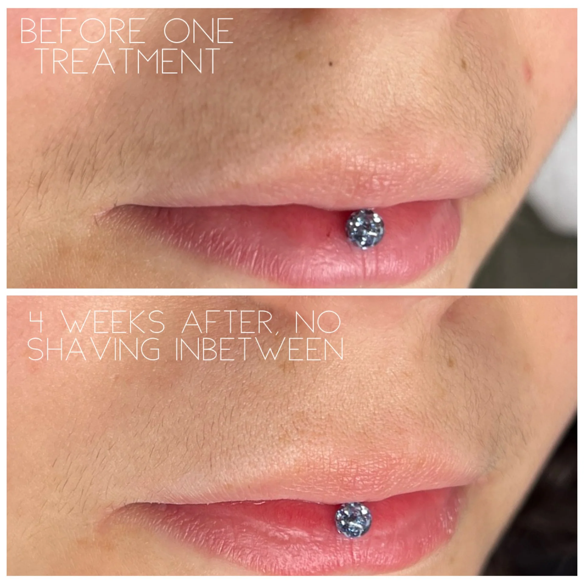 Before and after one laser hair removal treatment