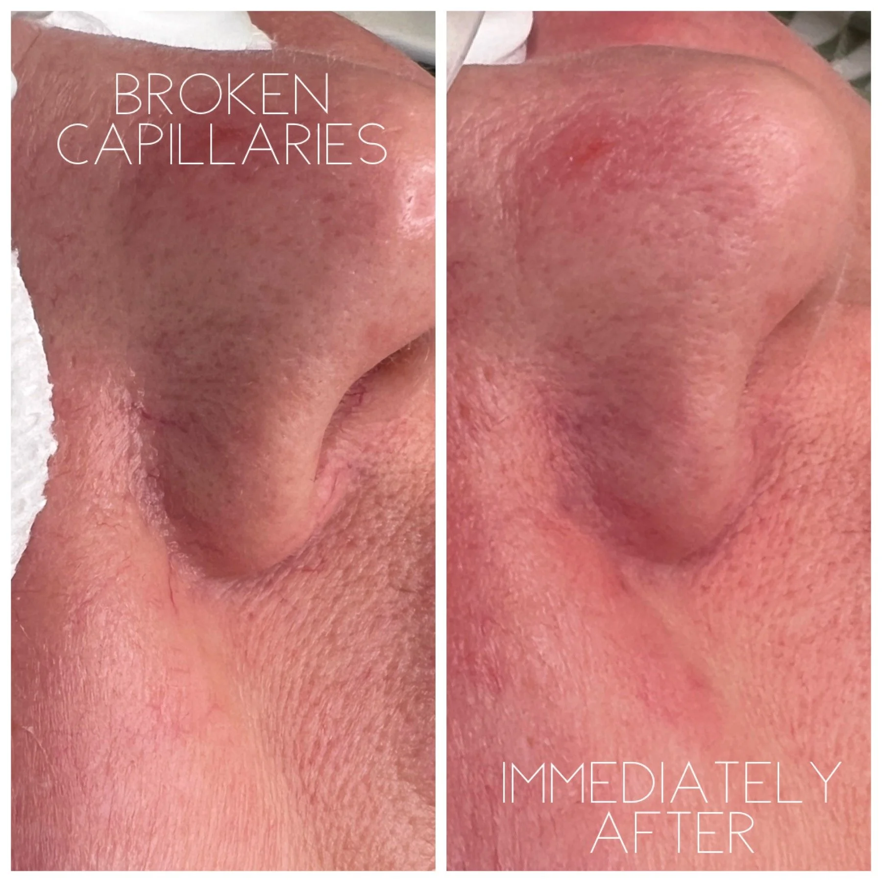 Before and after laser treatment for broken capillaries