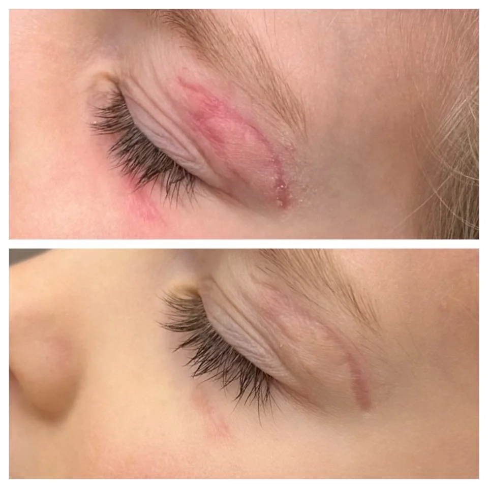 Before and after two laser treatments for scar removal
