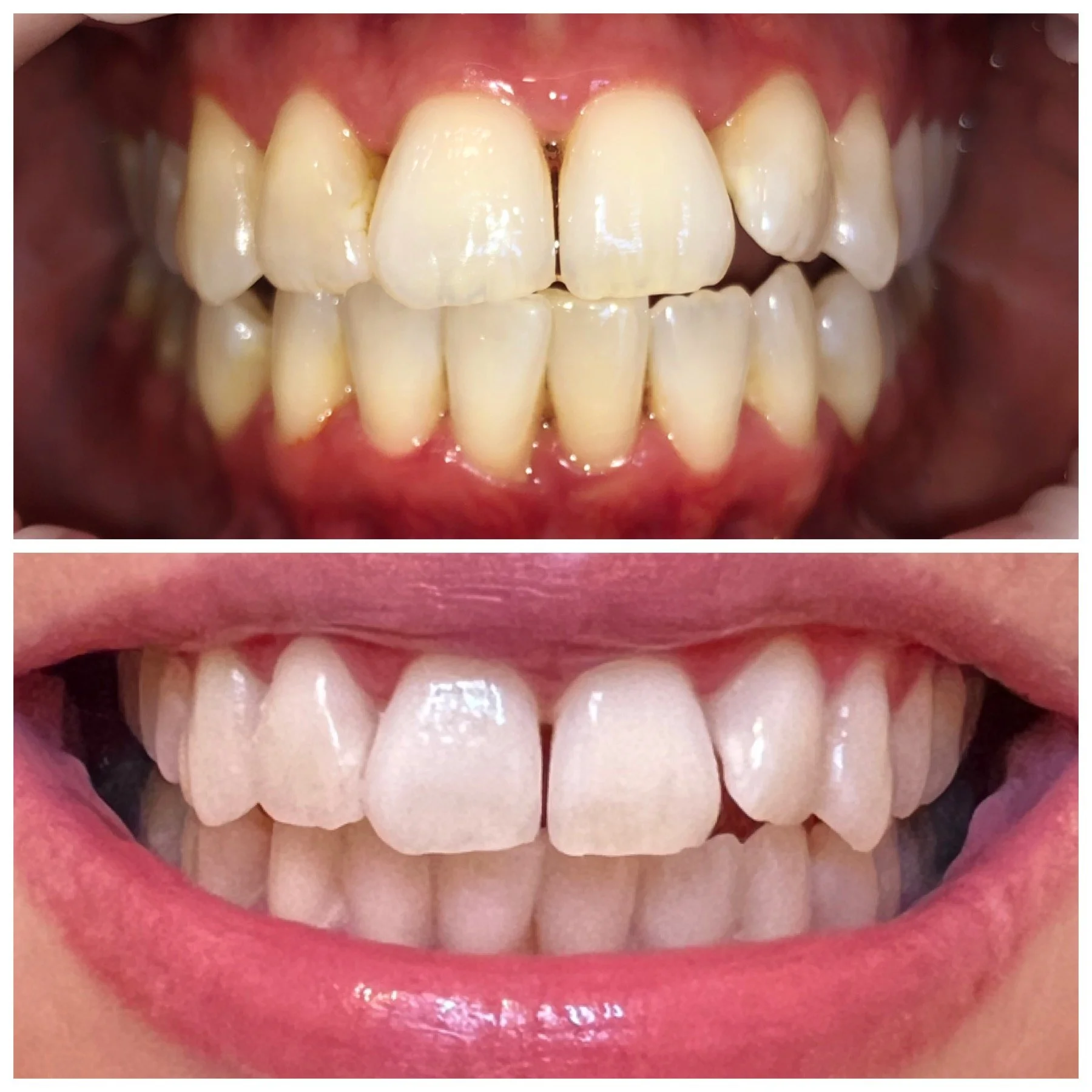 Before and after two teeth whitening sessions