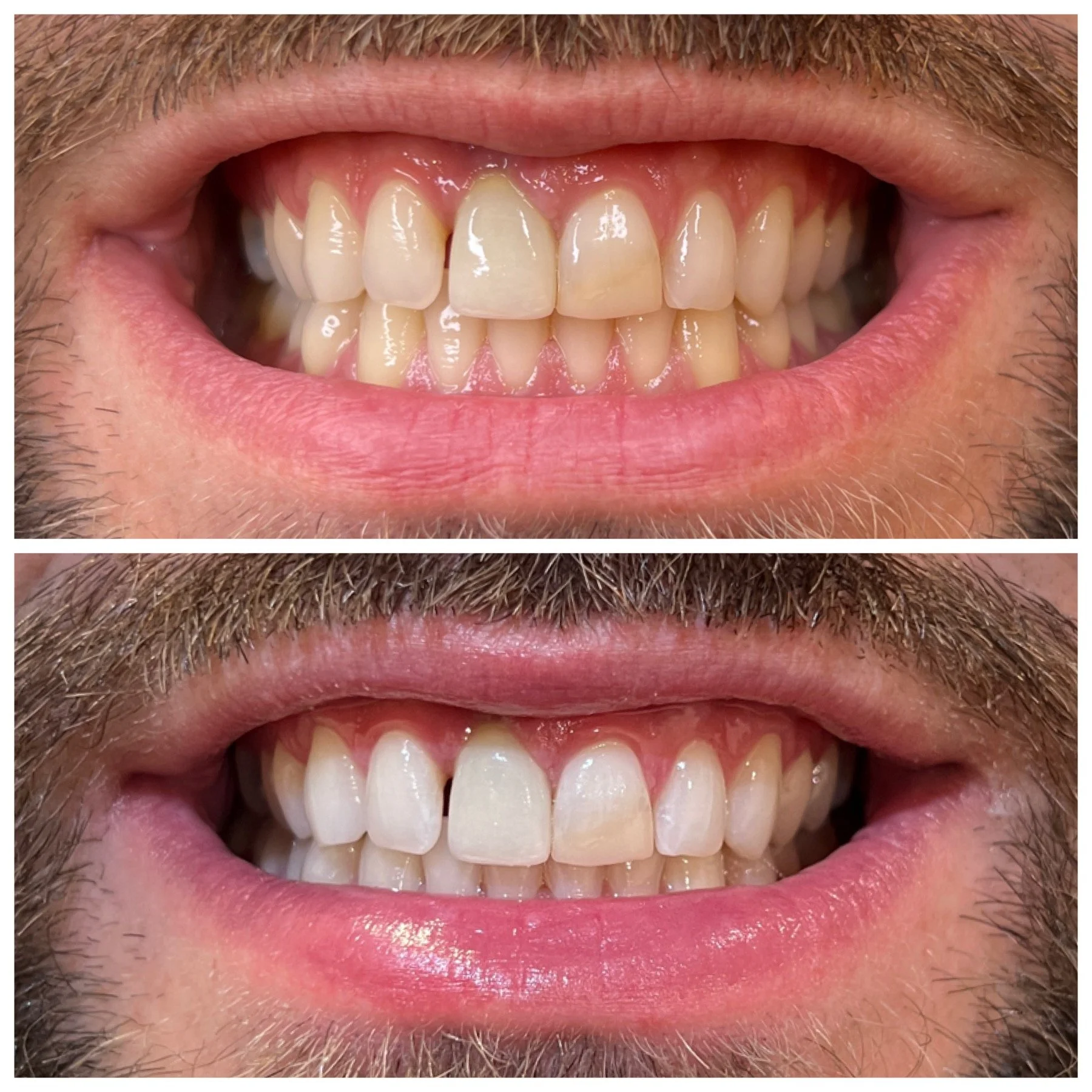 Before and after one teeth whitening session