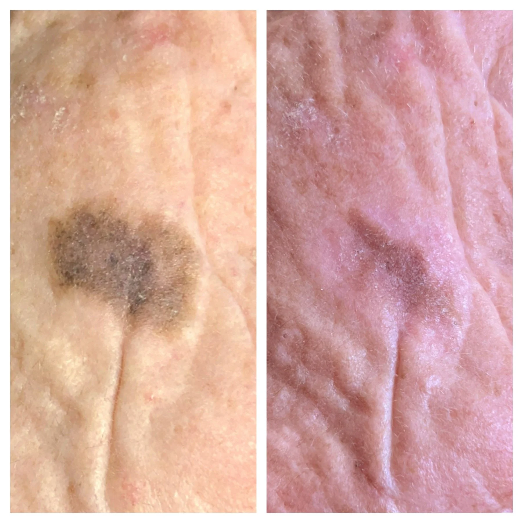 Before and after laser treatment for discolouration