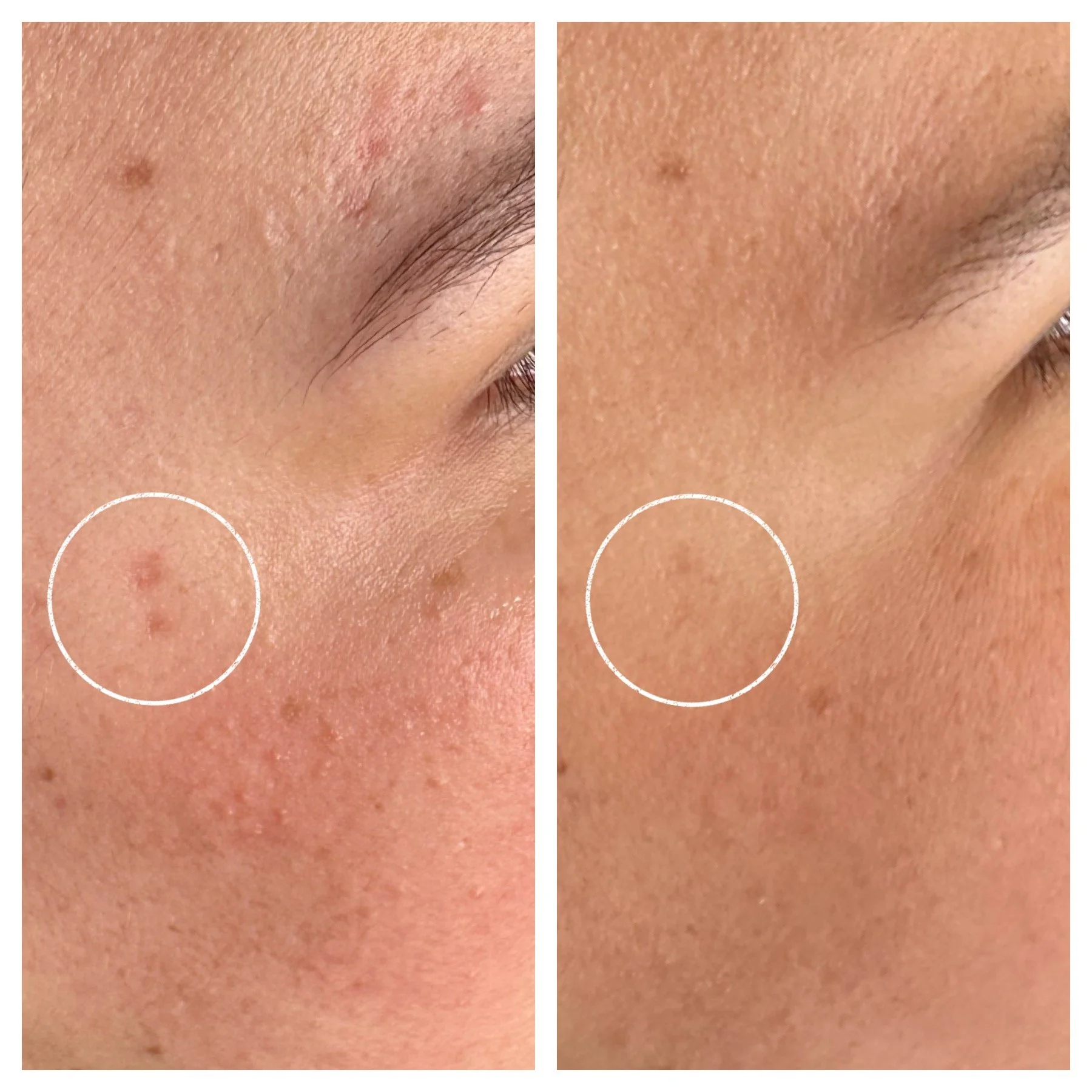 Side-by-side comparison of skin with acne and clear skin, with circles highlighting affected areas.